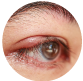 What is Blepharitis?