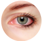Allergic Conjunctivitis