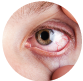 Eye infections when using lenses