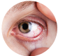 Dry Eye Syndrome